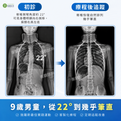 衡觀診所:32歲成人側彎女生,真實分享.png 衡觀診所:32歲成人側彎女生,真實分享.png