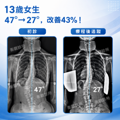 衡觀診所 13歲女生 腰彎47度  側彎矯正案例分享.png